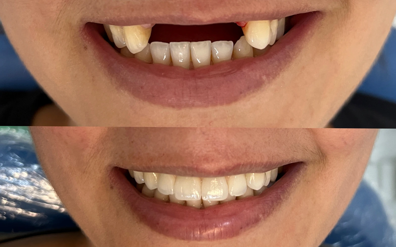 Antes e depois do caso odontológico 04