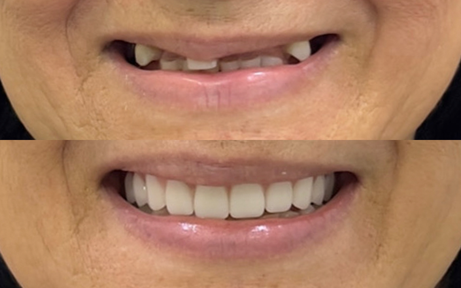 Transformação de sorriso realizada pela Dra. Joana Siqueira