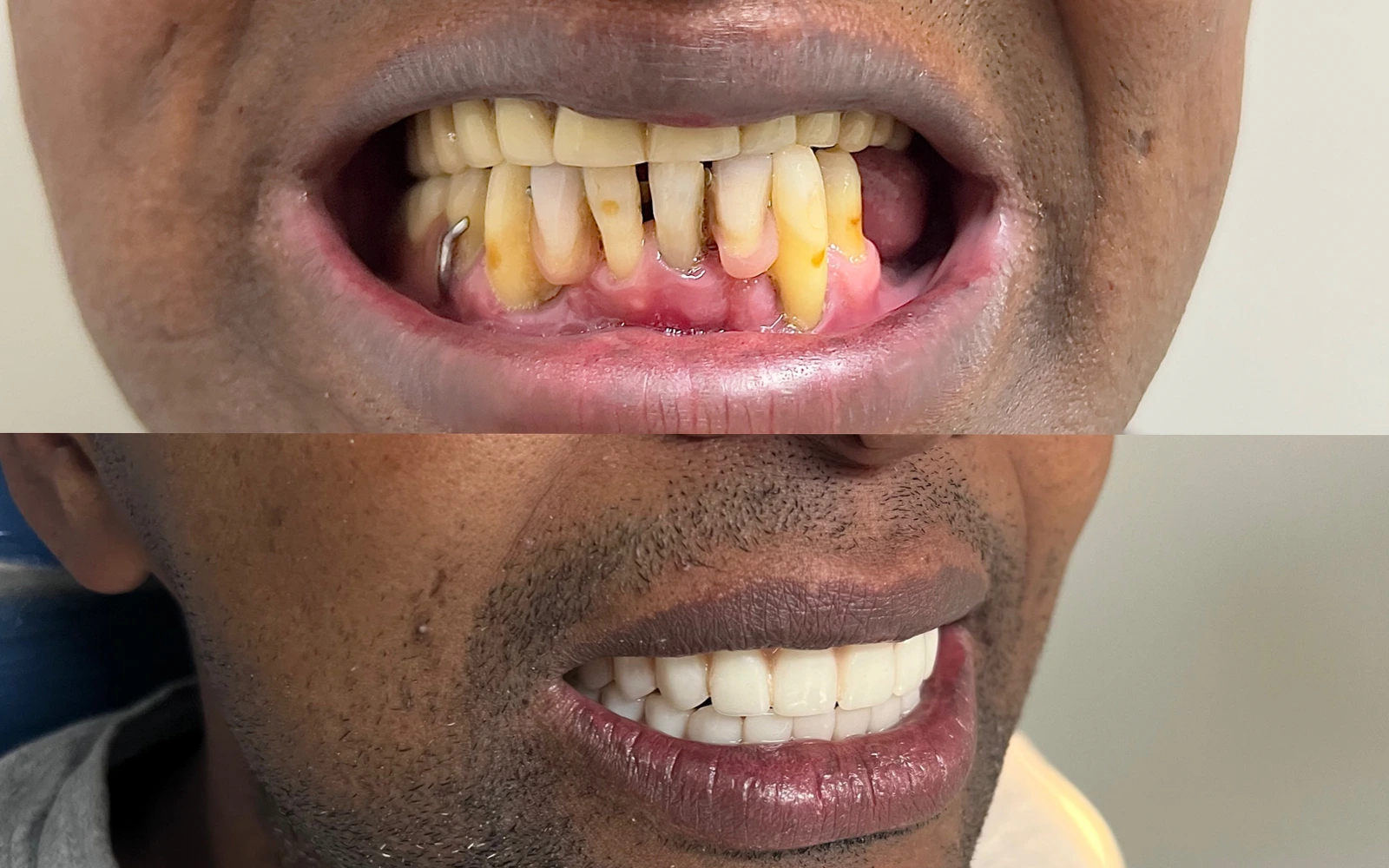 Antes e depois do caso odontológico 05
