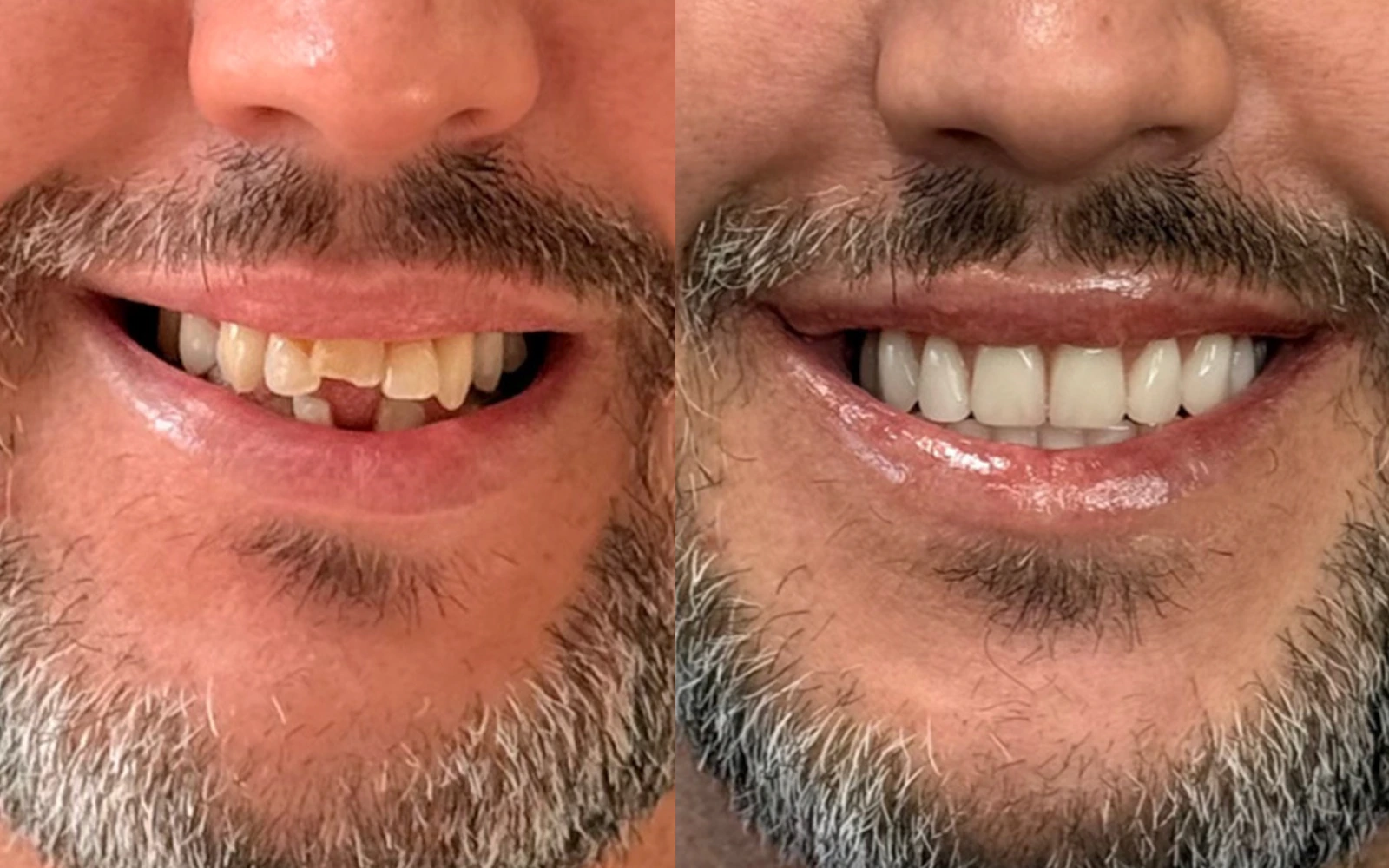 Antes e depois do caso odontológico 01
