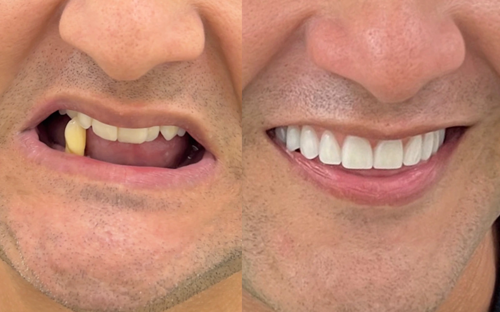 Antes e depois do caso odontológico 02