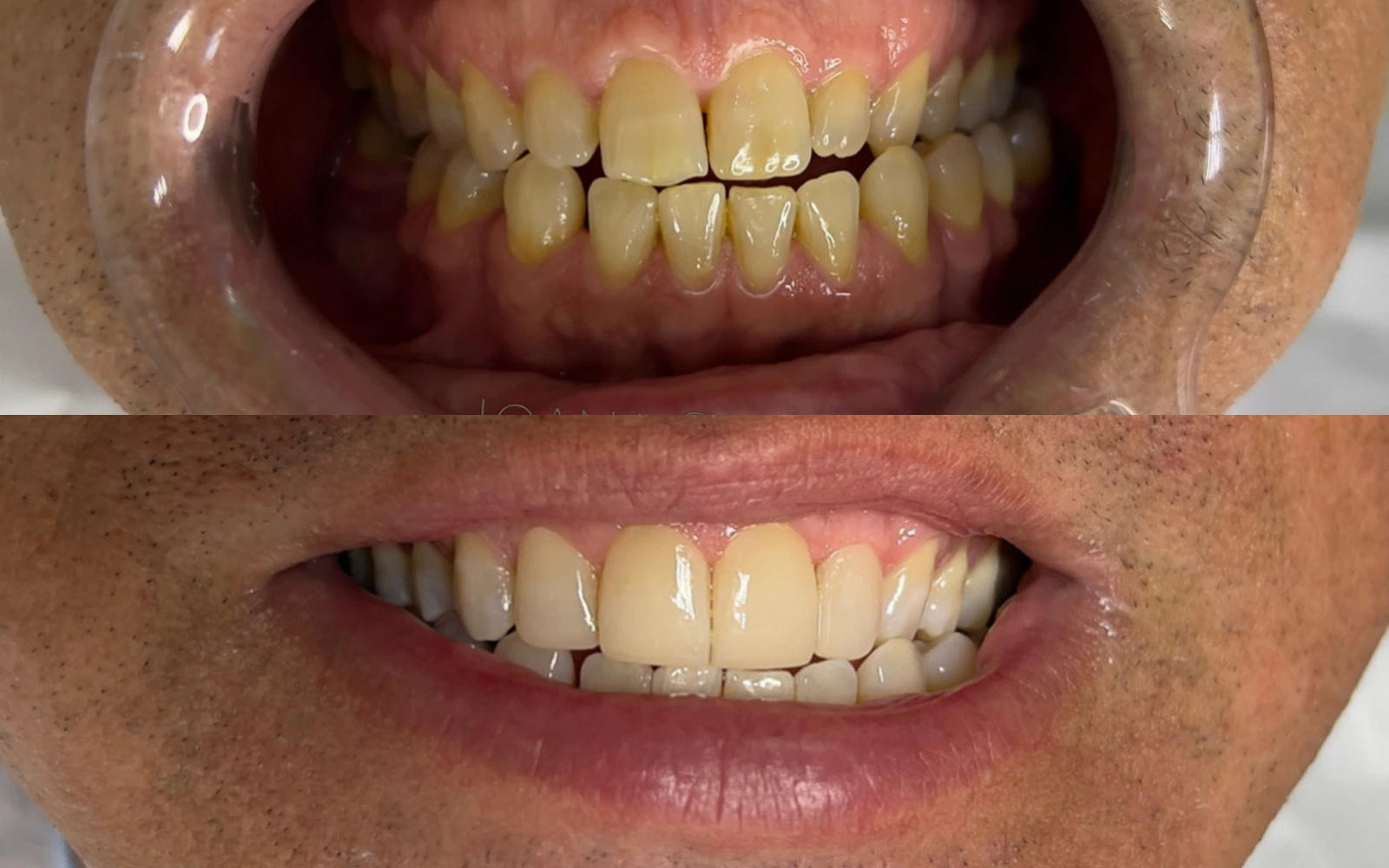 Antes e depois do caso odontológico 03