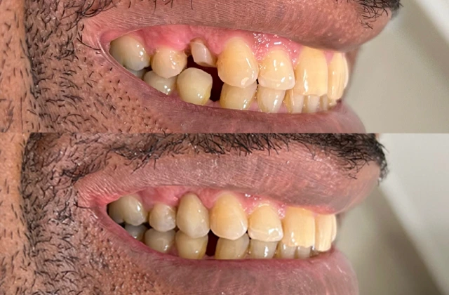 Implantes dentários